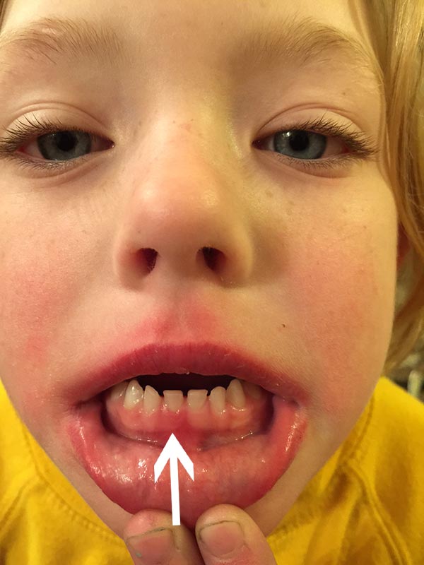 losing first tooth