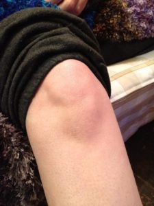 My sore knee